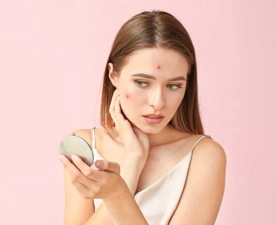 acne issue