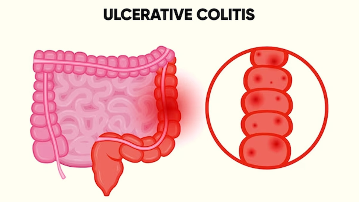 Ulcerative Colitis: Expert Explains The Disease And Lists Dietary
