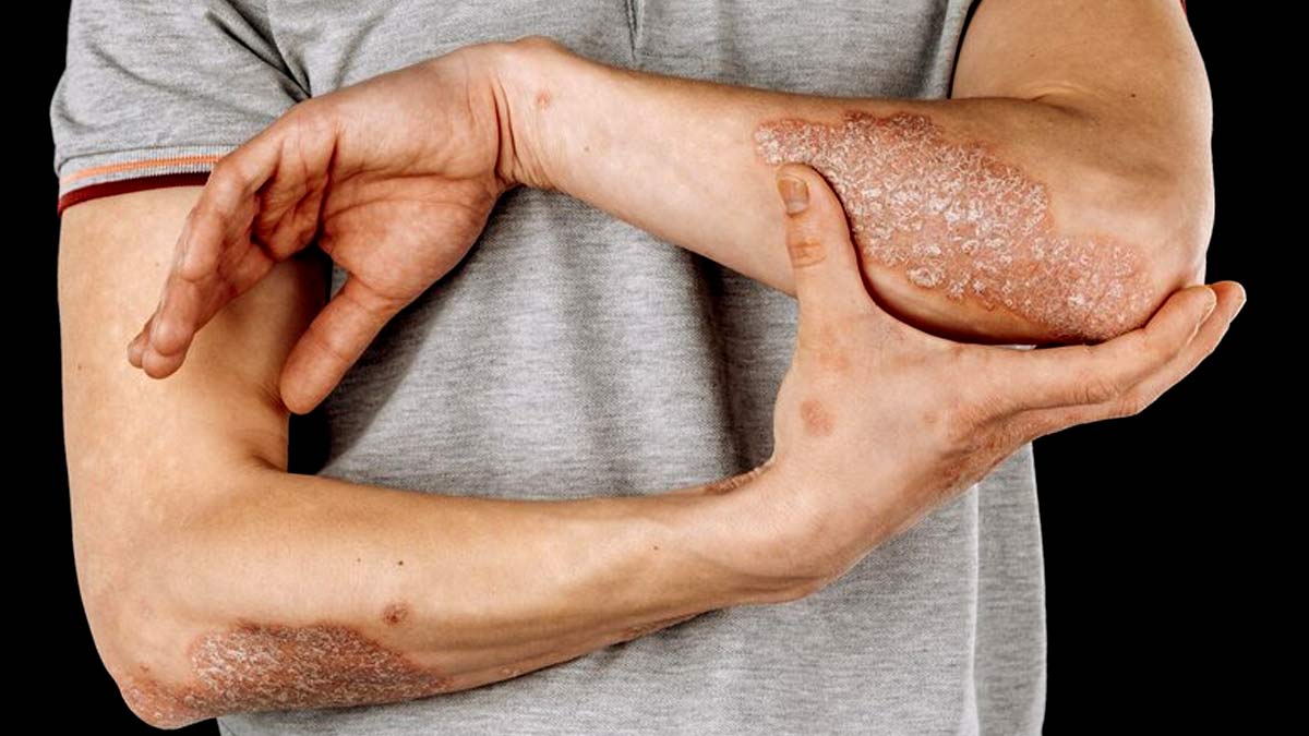 World Psoriasis Day 2023: 5 Common Triggers of Psoriasis You Should Be Aware Of