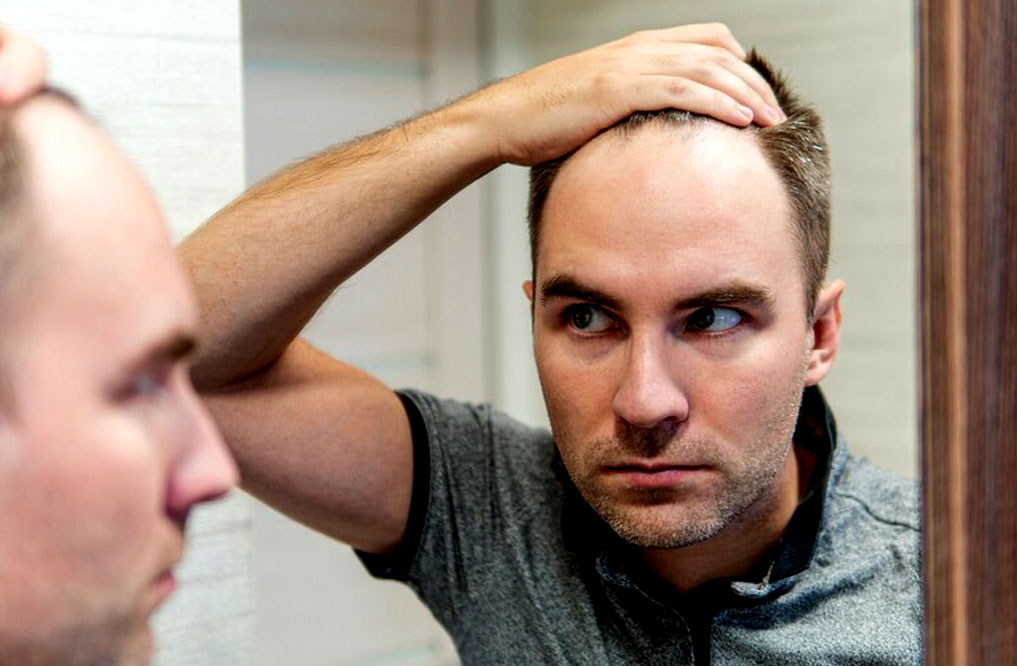 How To Prevent Balding Male