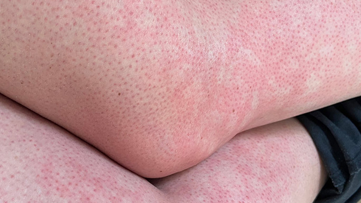 Toasted Skin Syndrome Caused By Laptop Heat