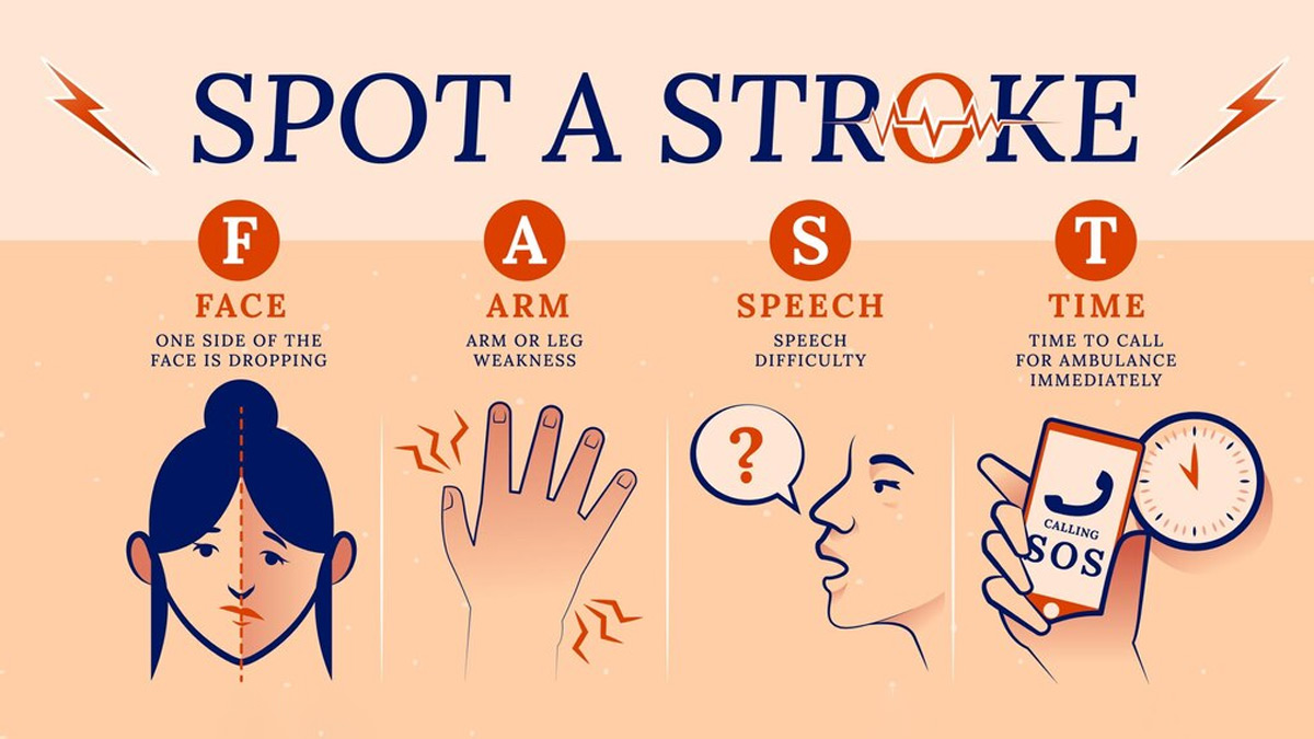 Face stroke. . Face Arm Speech Test.