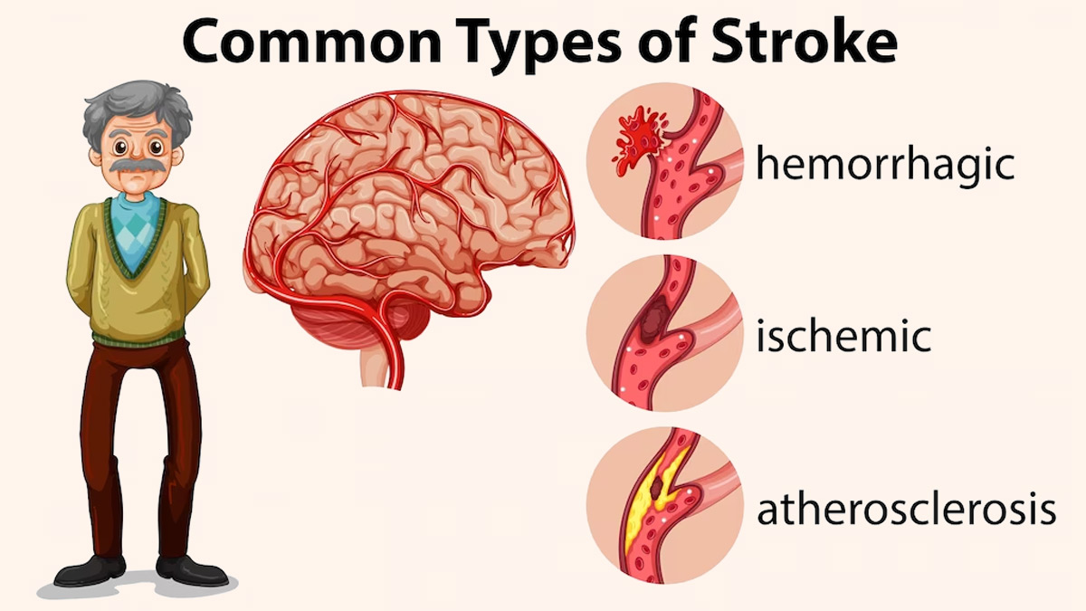 types-of-stroke