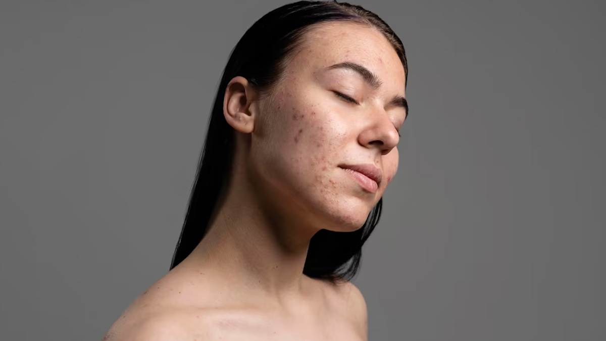 Unveiling The Gut-Skin Connection: An Expert's Guide to Understanding and Clearing Acne