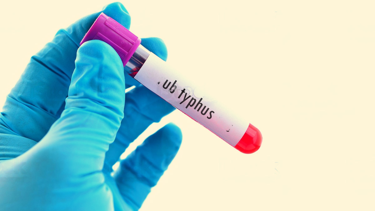 Scrub Typhus Claims Another Victim in Shimla Death Toll Reaches Five