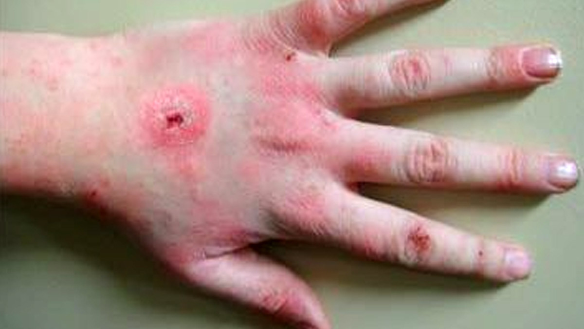 Scrub Typhus: शिमला में स्क्रब टायफस से 5वीं मौत, जानें इस बीमारी के लक्षण और बचाव के तरीके