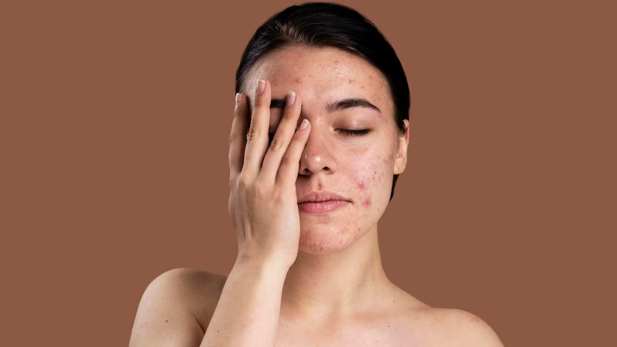 pimple patches