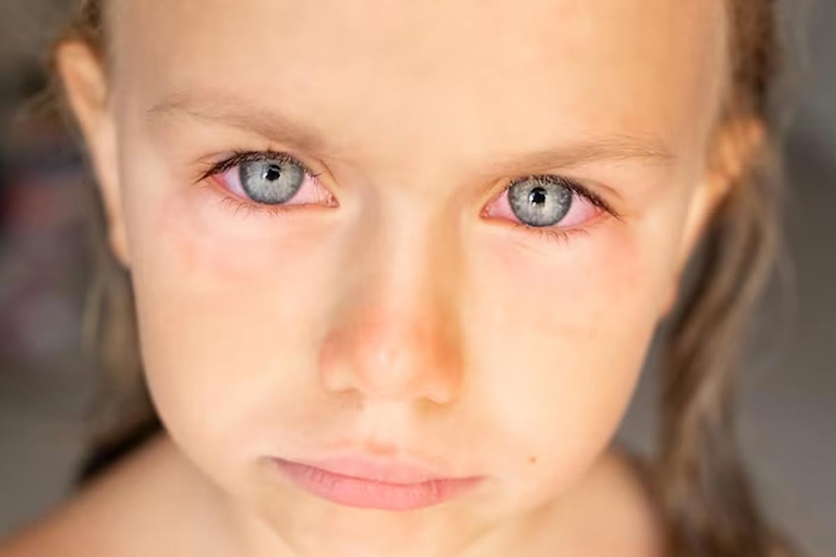 Detecting Eye Issues Early Expert Lists 10 Eye Problems In Children