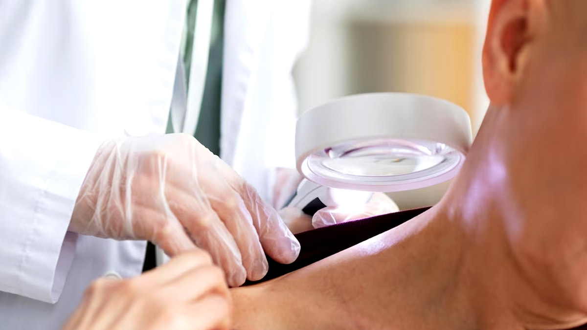 Is Mole On Your Skin Indicates Skin Cancer? Here's What You Need to Be Aware Of