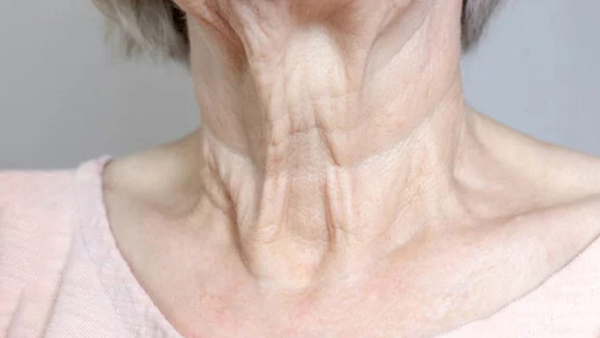 turkey neck treatment