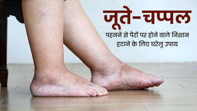 जूते-चप्पल पहनने से पैरों पर पड़े निशान को दूर करने के लिए अपनाएं ये 5 घरेलू उपाय