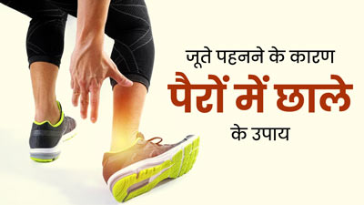 नए जूते पहनने के बाद पैरों में पड़ गए हैं छाले? इन 5 घरेलू उपायों से पाएं छुटकारा