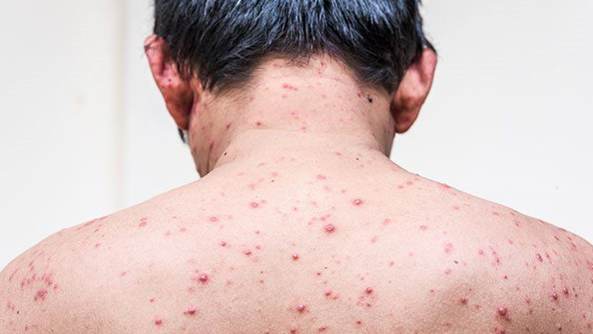 chickenpox