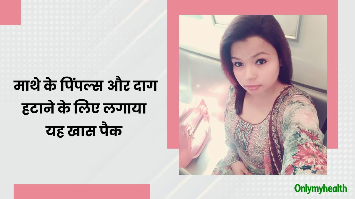 माथे पर हो गए थे पिंपल्स और दाग-धब्बे, इस पैक को लगाने से दूर हुई निशि की समस्याएं