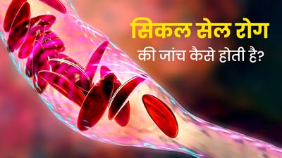 Sickle Cell Awareness Month 2023: खून से जुड़ी गंभीर बीमारी है सिकल सेल रोग, जानें कैसे होती है इसकी जांच 