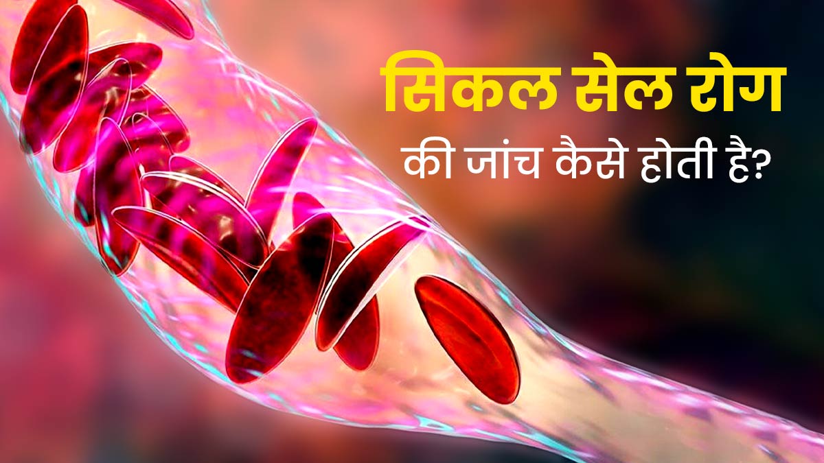 Sickle Cell Awareness Month 2023: खून से जुड़ी गंभीर बीमारी है सिकल सेल रोग, जानें कैसे होती है इसकी जांच 