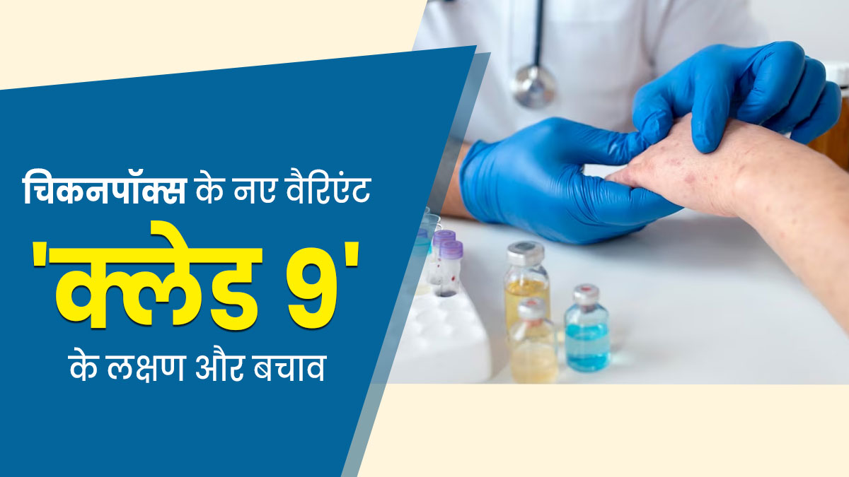 भारत में मिला चिकनपॉक्स का नया वैरिएंट ‘क्लैड 9’, जानें इसके लक्षण, कारण और बचाव के तरीके
