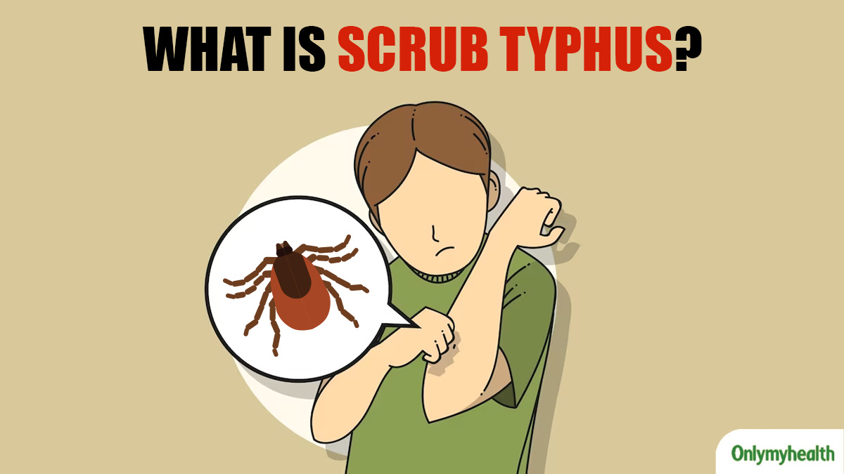 India On Alert As Scrub Typhus Claims 14 Lives, Here’s Everything You Should Know About This Deadly Disease