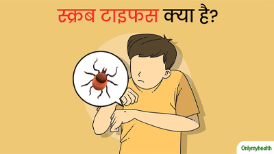 हिमाचल और उड़ीसा में फैल रहा स्क्रब टाइफस संक्रमण क्या है? जानें इसके कारण, लक्षण, इलाज और बचाव के उपाय