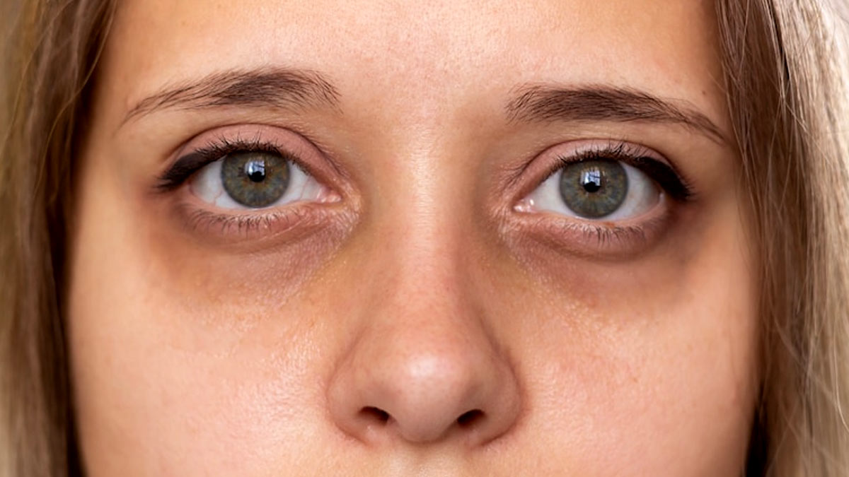 Can You Get Rid Of Your Dark Circles Here S What The Dermatologist Says OnlyMyHealth