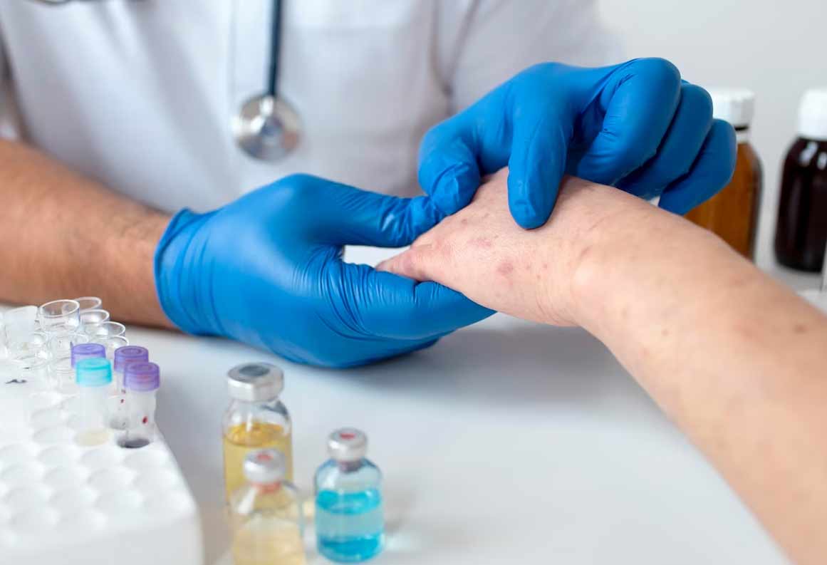 Systemic-Lupus-Erythematosus 