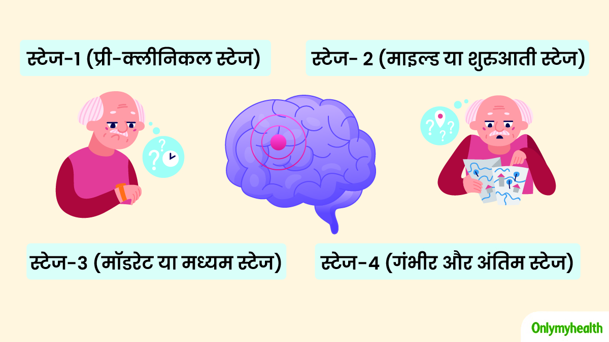 alzheimer's disease stages