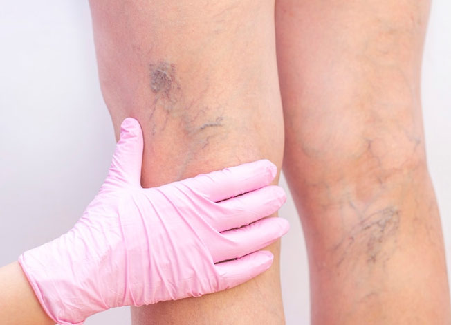 vitamin deficiency and varicose veins