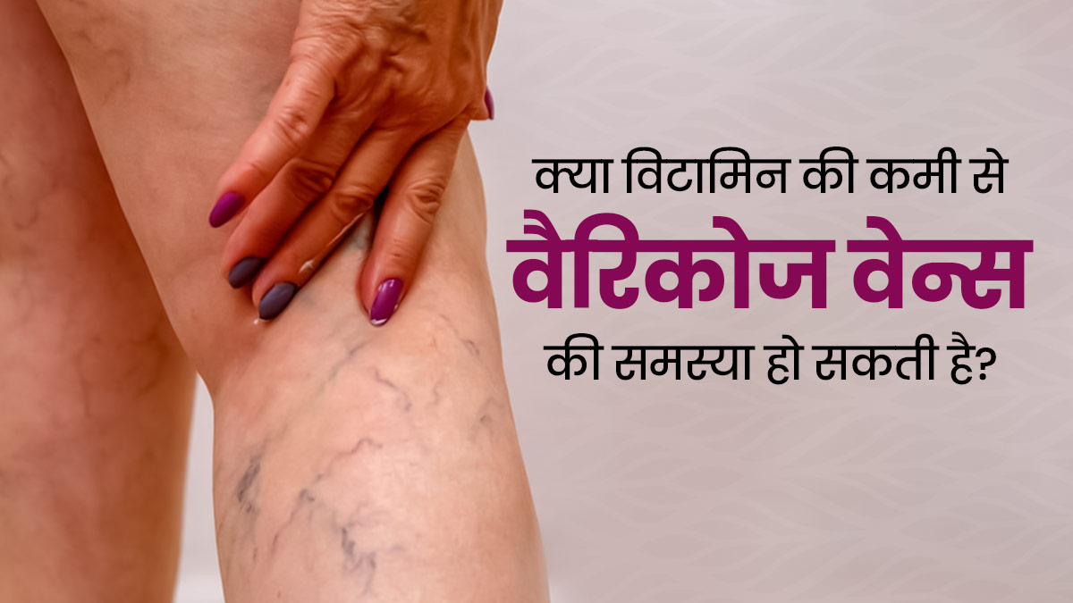 क्या विटामिन की कमी से वैरिकोज वेन्स की समस्या हो सकती है? जानें क्या कहते हैं डॉक्टर
