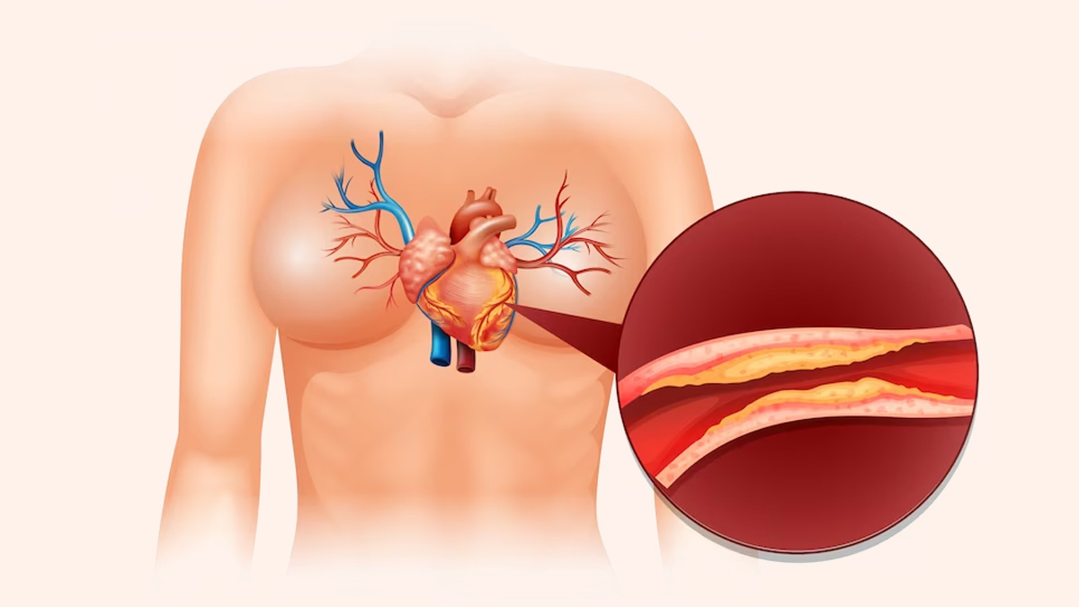 Low HDL Cholesterol Symptoms In Hindi