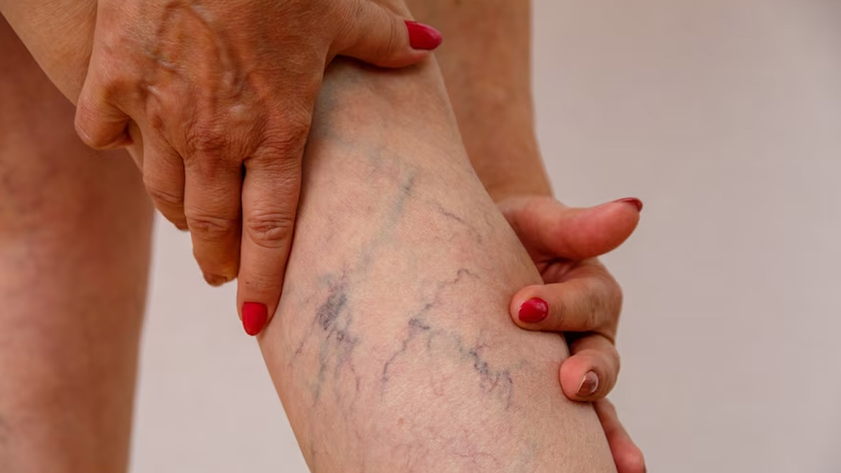varicose veins for ayuveda