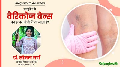 Varicose Veins: आयुर्वेद में वैरिकोज वेन्स (उभरी नीली नसों) का इलाज कैसे किया जाता है? आयुर्वेदाचार्य से जानें