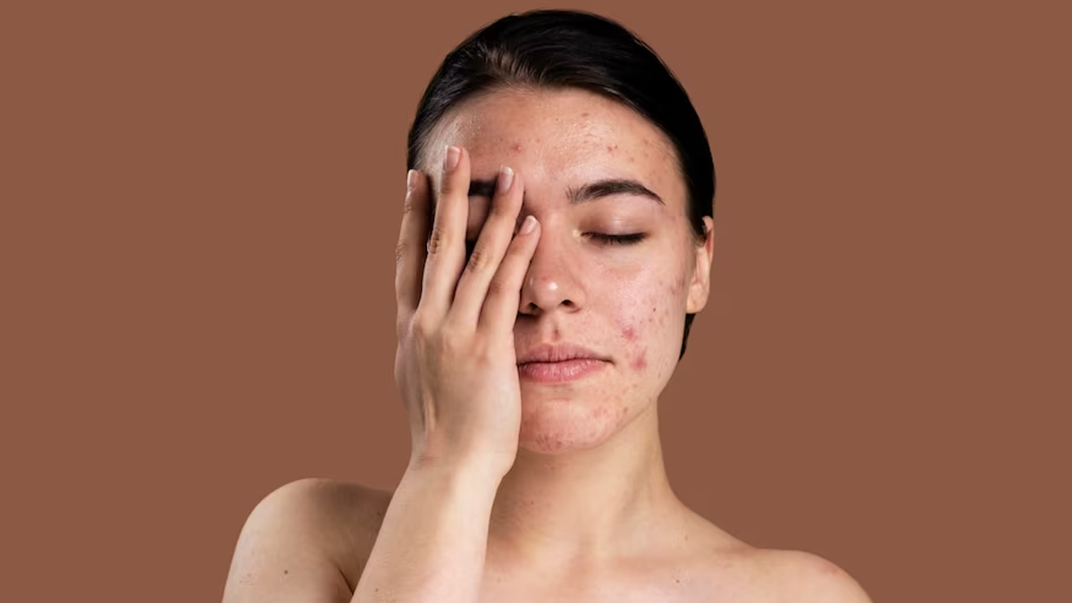 iron deficiency and melasma 