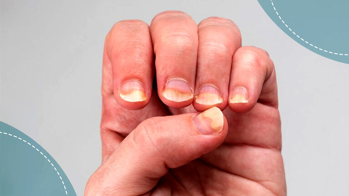 No Moons on Fingernails: What Does It Mean?