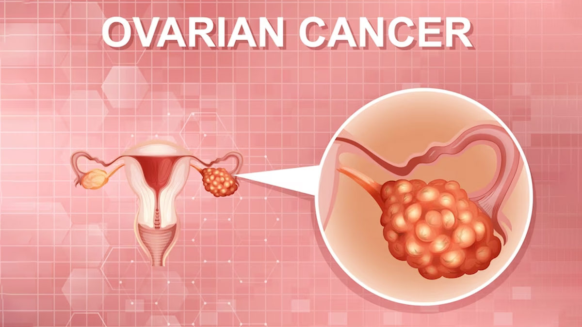 ovarian-cancer