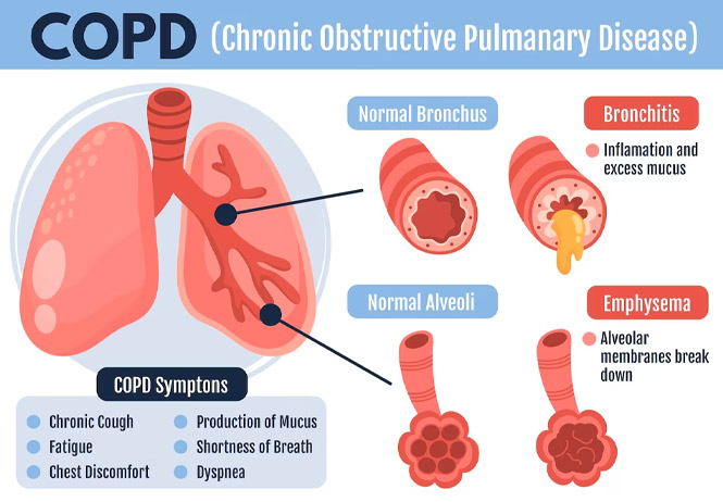 COPD