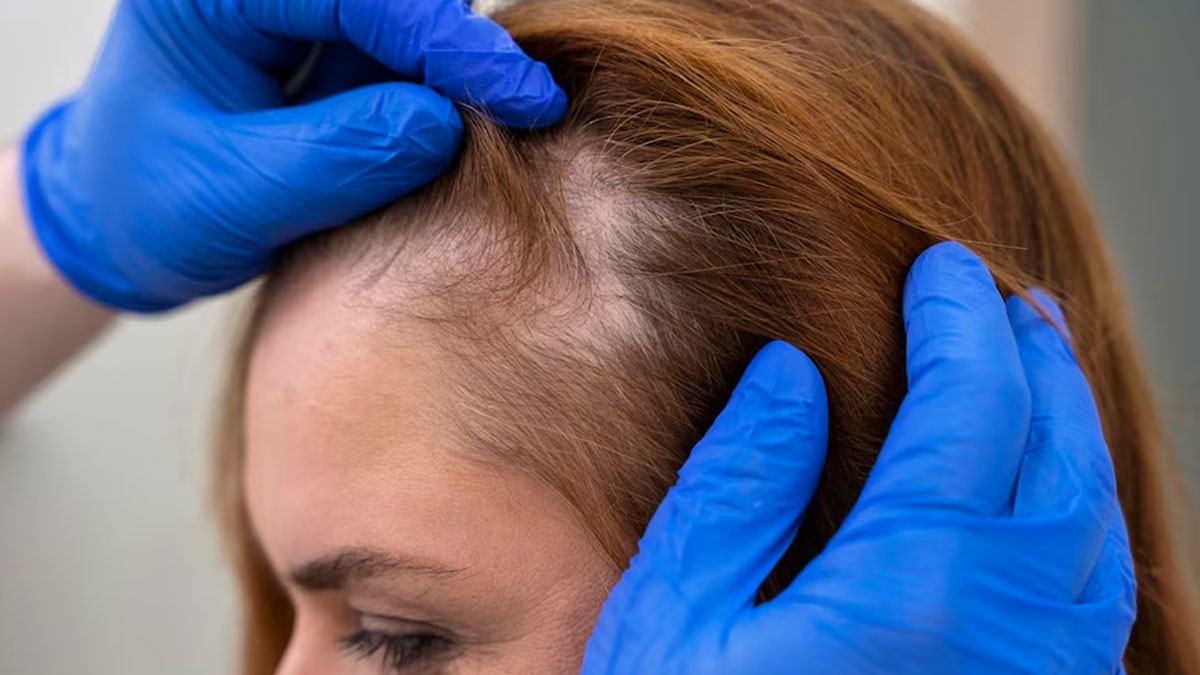 Alopecia Warning Signs