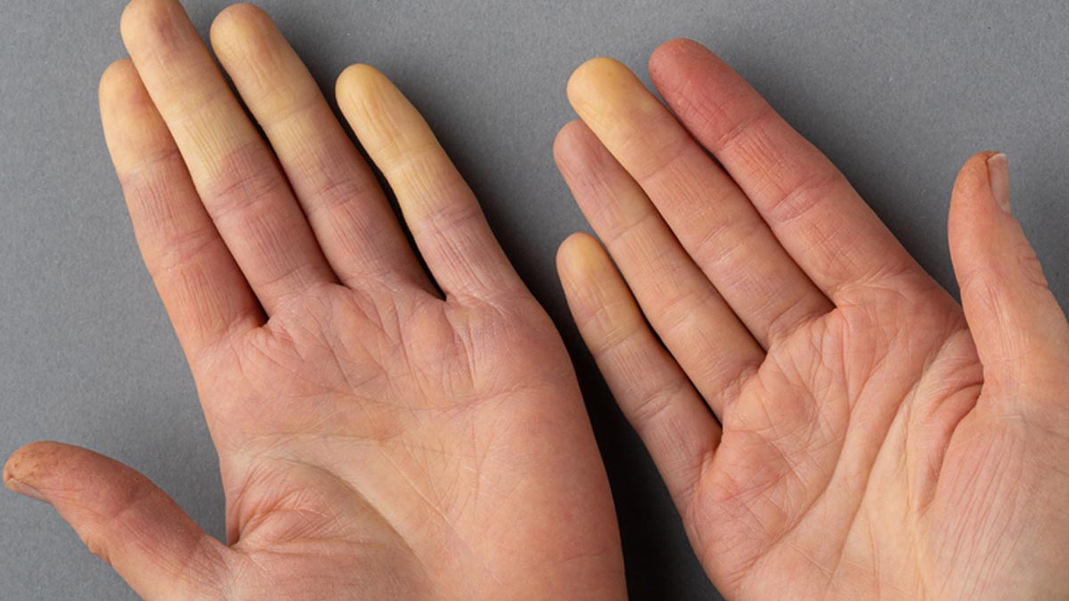 Signs That You Have An Autoimmune Disorder OnlyMyHealth signs-that-you-have-an-autoimmune-disorder-onlymyhealth