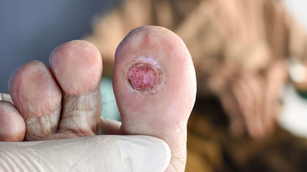 Spinach For Diabetic Foot Ulcer