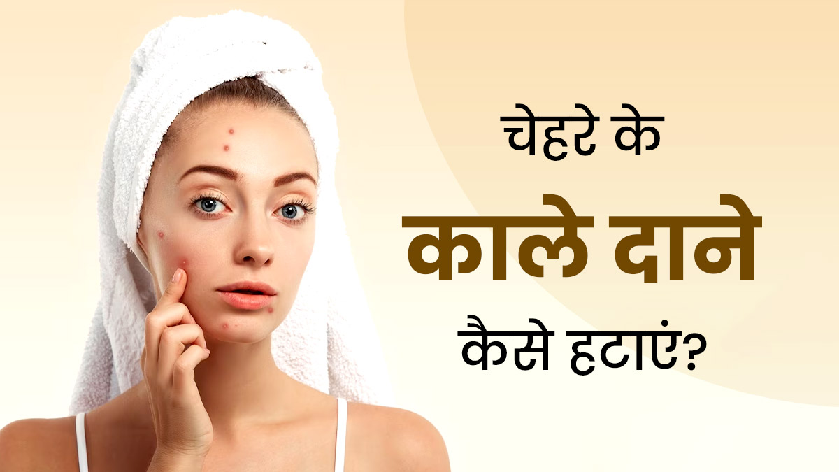 चेहरे के काले दाने कैसे हटाएं? जानें 5 उपाय, जिनसे त्वचा पर आएगा निखार