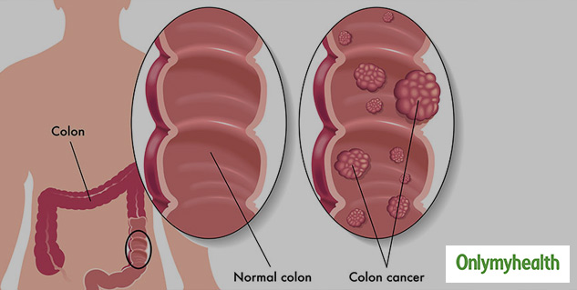 Common Causes and Symptoms of of Colon Cancer in Young Adults
