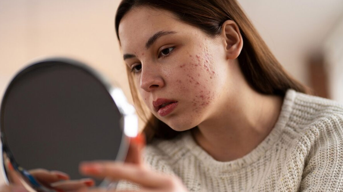 Common Myths and Misconceptions About Skincare and Acne Marks Debunked By Dermatologist