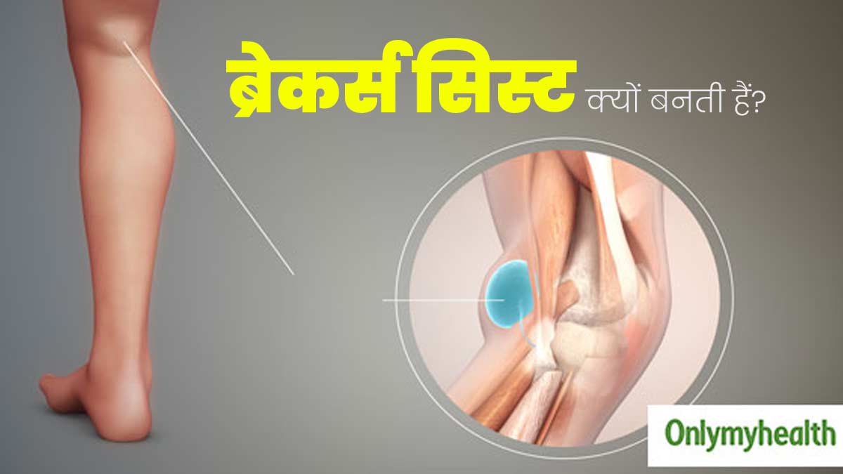 Baker's Cyst: घुटनों के पीछे गांठ क्यों बनती है? डॉक्टर से जानें इसके 5 कारण