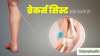 Baker's Cyst: घुटनों के पीछे गांठ क्यों बनती है? डॉक्टर से जानें इसके 5 कारण