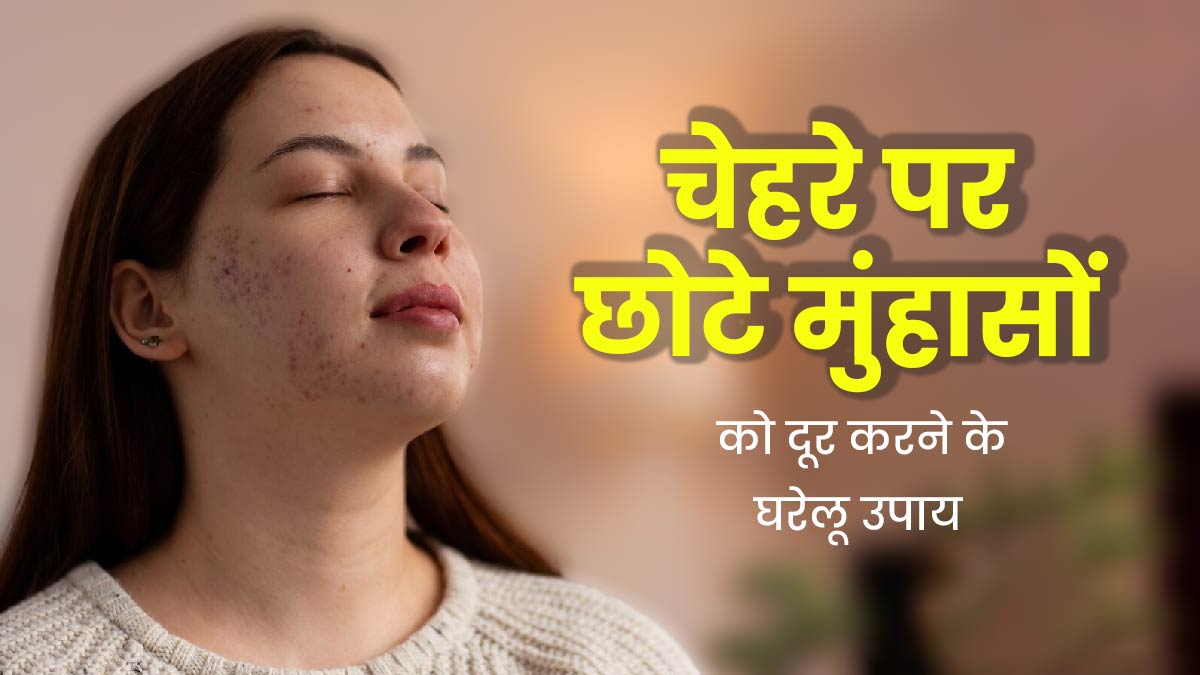 छोटे पस से भरे मुंहासों को इन घरेलू उपायों से करें ठीक, पाएं बेदाग चेहरा  