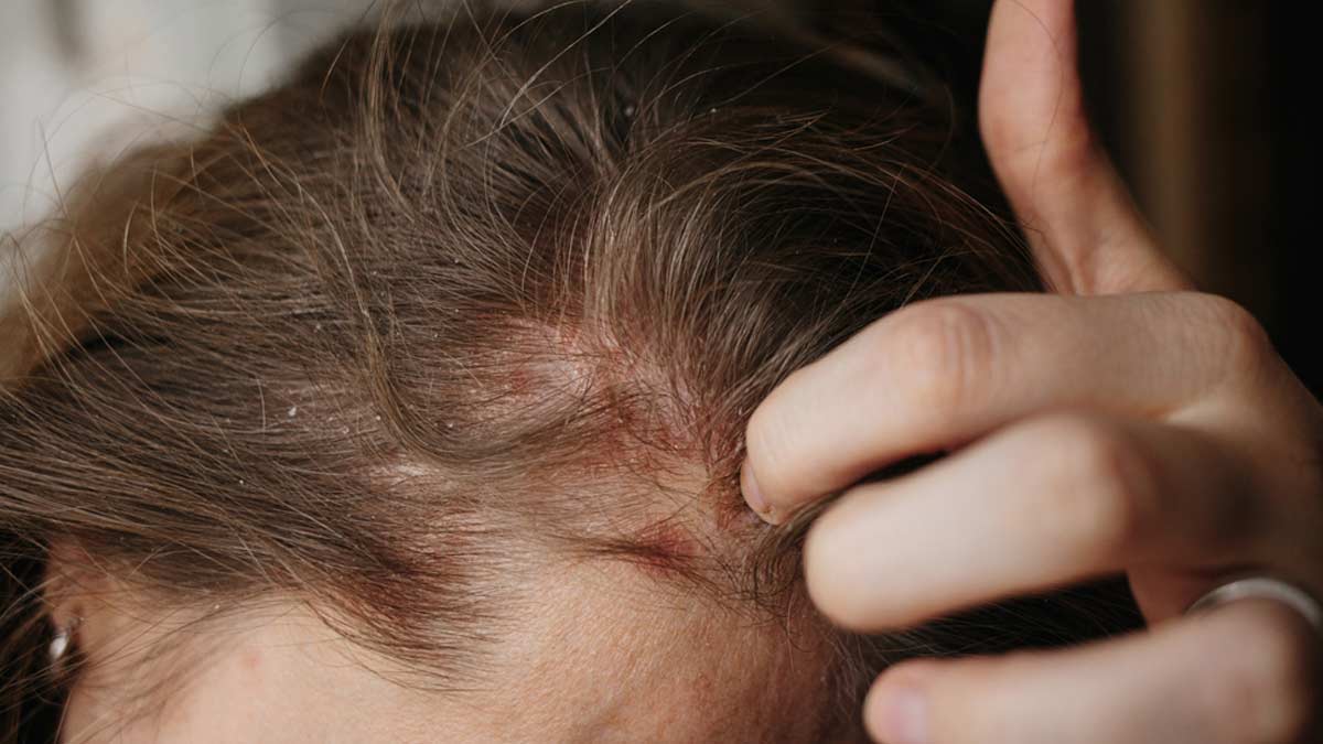 Dry Scaly Patches On Scalp? Follow These Herbal Home Remedies To Promote Scalp Health