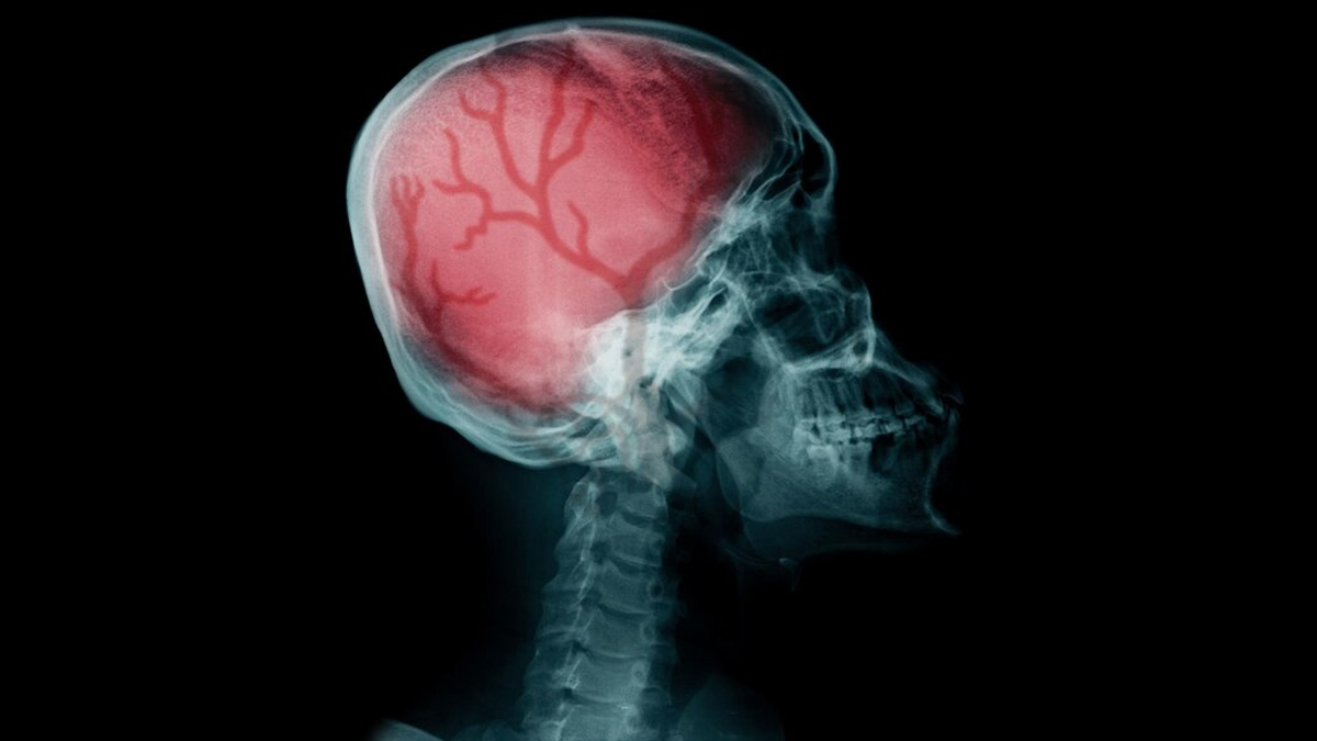 Expert Recommends Tips To Avoid Long-Lasting Effects Of A Traumatic Brain Injury
