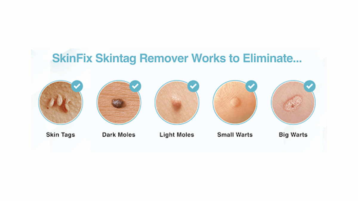 What are skin tags and moles