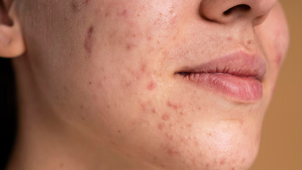 Dealing With Marks On Skin? Follow These Home Remedies To Get Rid Of Blemishes
