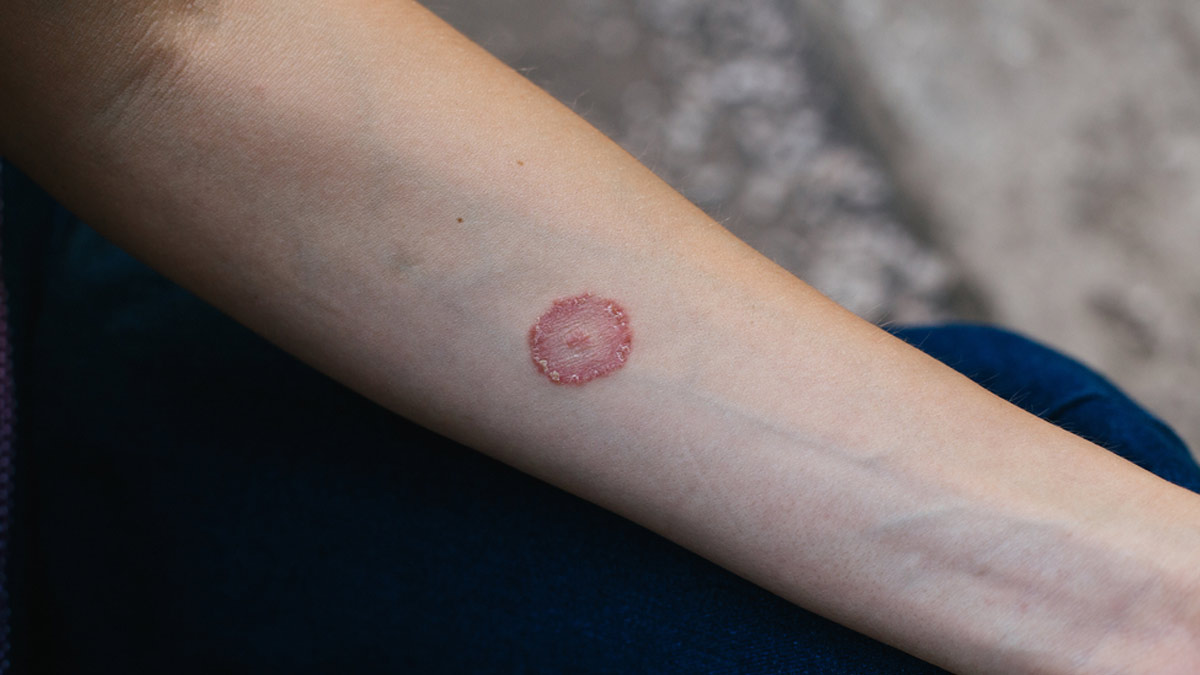 Here’s How You Can Treat Ringworm Infection At Home