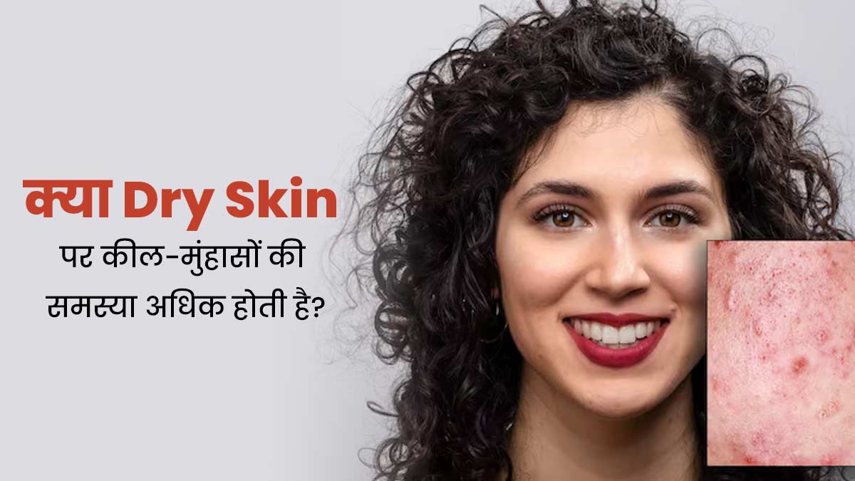 Dry Skin: क्या ड्राई स्किन पर कील-मुंहासे अधिक होते हैं? जानें एक्सपर्ट ...